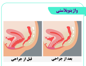 واژینوپلاستی