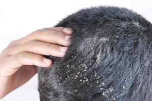 چرا باید از شامپو سولفات فری استفاده کنیم؟ 3 dandruff hair