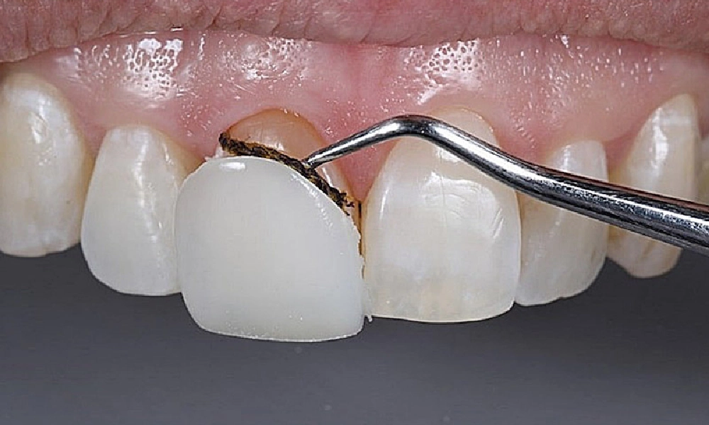 انواع کامپوزیت دندان